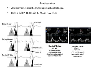 Iterative method
• Most common echocardiographic optimization technique.
• Used in the CARE-HF and the SMART-AV trials
 