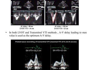 • In both LVOT and Transmitral VTI methods , A-V delay leading to max
value is used as the optimum A-V delay.
 