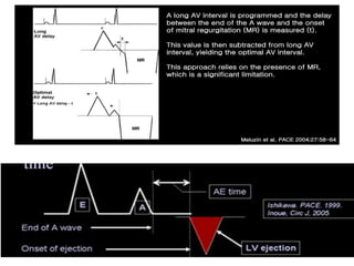 • Both the method depends on minimizing the diastolic MR for optimal A-V
delay.
 