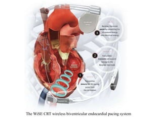 The WiSE CRT wireless biventricular endocardial pacing system
 