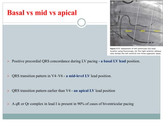 Basal vs mid vs apical
 Positive precordial QRS concordance during LV pacing - a basal LV lead position.
 QRS transition pattern in V4–V6 - a mid-level LV lead position.
 QRS transition pattern earlier than V4 - an apical LV lead position
 A qR or Qr complex in lead I is present in 90% of cases of biventricular pacing
 