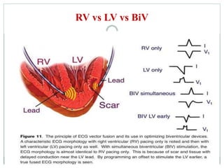 RV vs LV vs BiV
 