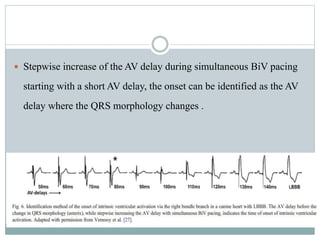  Stepwise increase of the AV delay during simultaneous BiV pacing
starting with a short AV delay, the onset can be identified as the AV
delay where the QRS morphology changes .
 