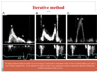Iterative method
AV delays that are either too short (A) or too long (C) will result in truncation of the A wave of mitral inflow or E and A
wave fusion, respectively. At the optimal AV delay, E and A wave separation results in maximum diastolic filling time
without truncation of the A wave
 