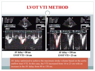 LVOT VTI METHOD
AV delay optimized to achieve the maximum stroke volume based on the aortic
outflow tract VTI. In this case, the VTI increased from 16 to 23 cm with an
increase in the AV delay from 80 to 150 ms.
 