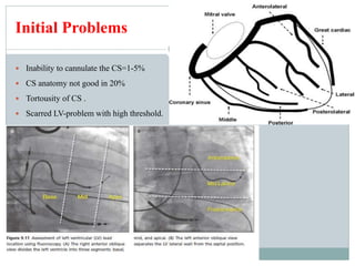 Initial Problems
 Inability to cannulate the CS=1-5%
 CS anatomy not good in 20%
 Tortousity of CS .
 Scarred LV-problem with high threshold.
 