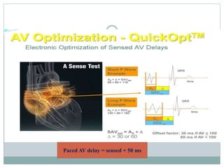 Paced AV delay = sensed + 50 ms
 