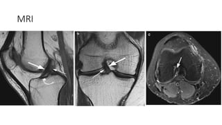Cruciate ligament injuries OF KNEE (ACL AND PCL) | PPTX