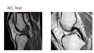 Cruciate ligament injuries OF KNEE (ACL AND PCL) | PPTX