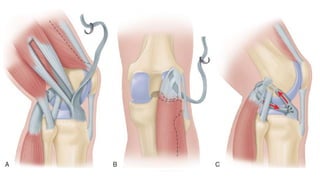 Cruciate ligament injuries OF KNEE (ACL AND PCL) | PPTX