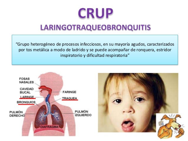 Sindrome De Crup – Crup (laringotraqueobronquitis) – NWEW
