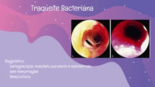 Traqueíte Bacteriana
Diagnóstico:
- Laringoscopia: exsudato purulento e malcheiroso,
sem hemorragias
- Hemocultura
 