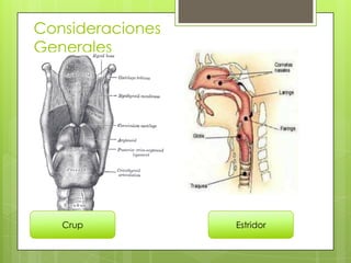 Consideraciones
Generales

Crup

Estridor

 