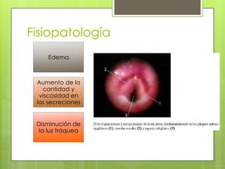 Fisiopatología
Edema

Aumento de la
cantidad y
viscosidad en
las secreciones
Disminución de
la luz tráquea

 