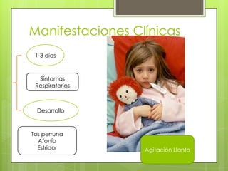 Manifestaciones Clínicas
1-3 días

Síntomas
Respiratorios

Desarrollo

Tos perruna
Afonía
Estridor

Agitación Llanto

 