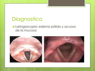 Diagnostico
 Laringoscopia:

de la mucosa

edema pálido y acuoso

 