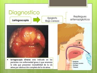 Diagnostico
Laringoscopia

Epiglotis
Rojo cereza

Repliegues
aritenopigloticos

 