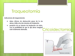 Traqueotomía

Cricoidectomia

 