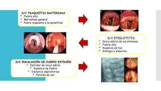 Traqueitis Rx CRUP_ expo viral, estridor laringeo .pptx