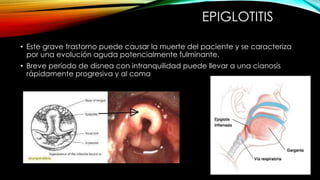 EPIGLOTITIS
• Este grave trastorno puede causar la muerte del paciente y se caracteriza
por una evolución aguda potencialmente fulminante.
• Breve período de disnea con intranquilidad puede llevar a una cianosis
rápidamente progresiva y al coma
 