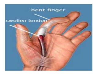 Crush injuries of hand | PPTX