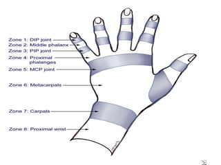 Crush injuries of hand | PPTX
