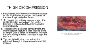 THIGH DECOMPRESSION
1. Longitudinal incision over the lateral aspect
of the thigh from the greater trochanter to
the lateral epicondyle of femur
2. To release the anterior compartment , the
iliotibial tract is incised and the vastus
lateralis is reflected off the intermuscular
septum bluntly
3. To release the posterior compartment, the
intermuscular septum is then incised along
its length (not to close to the femur to avoid
the perforating arteries passing through the
septum)
4. The medial adductor compartment is
released through a separate anteromedial
incision
 