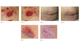 Técnica de Crusting con Cianoacrilato para Dermatitis Asociada a ...