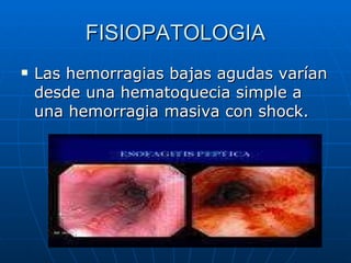 FISIOPATOLOGIA Las hemorragias bajas agudas varían desde una hematoquecia simple a una hemorragia masiva con shock. 
