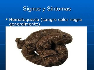 Signos y Síntomas Hematoquezia (sangre color negra generalmente). Pérdida lenta pero profusa, generalmente en el colon derecho o de una lesión mas proximal. Asintomática. Dolor abdominal a enfermedades asociadas (colitis, enfermedades inflamatorias). 