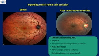 CENTRAL RETINAL VEIN OCCLUSION . RETINA. | PPTX
