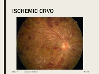 ISCHEMIC CRVO
13-Jan-24 Retinal Vein Occlusion Page 16
 