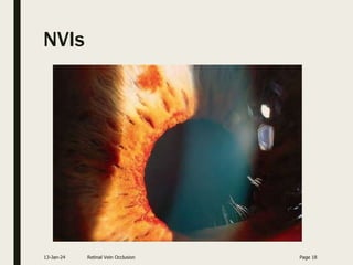 NVIs
13-Jan-24 Retinal Vein Occlusion Page 18
 
