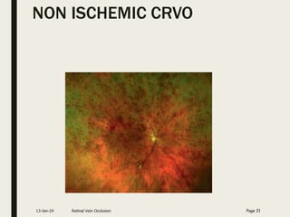 NON ISCHEMIC CRVO
13-Jan-24 Retinal Vein Occlusion Page 21
 