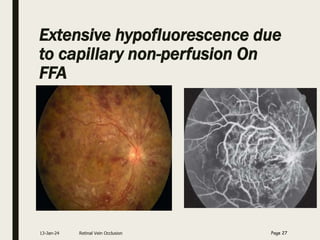Extensive hypofluorescence due
to capillary non-perfusion On
FFA
13-Jan-24 Retinal Vein Occlusion Page 27
 