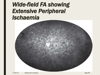Wide-field FA showing
Extensive Peripheral
Ischaemia
13-Jan-24 Retinal Vein Occlusion Page 28
 