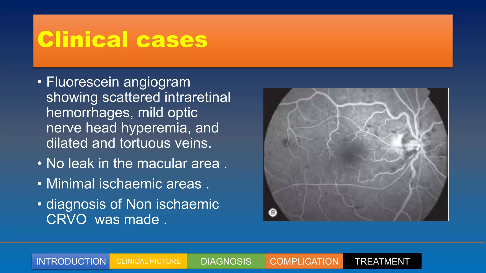INTRODUCTION CLINICAL PICTURE DIAGNOSIS COMPLICATION TREATMENT
Clinical cases
• Fluorescein angiogram
showing scattered intraretinal
hemorrhages, mild optic
nerve head hyperemia, and
dilated and tortuous veins.
• No leak in the macular area .
• Minimal ischaemic areas .
• diagnosis of Non ischaemic
CRVO was made .
 