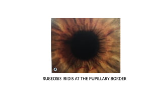 Subtle Rubeosis CRVO clinical evaluation, diagnosis.pptx