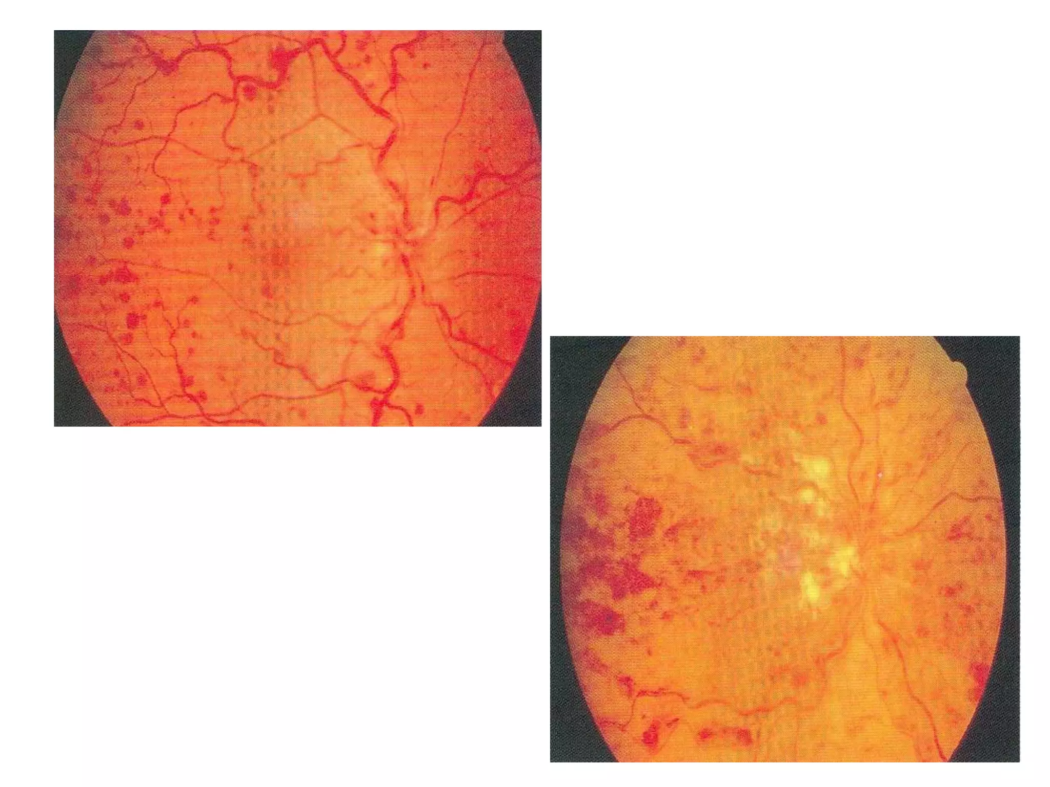  HEMI-CENTRAL RETINAL VEIN OBSTRUCTION