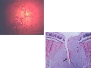Complications of intravitrealthrombolysis include vitreous haemorrhage and an increase in macular oedema.Drawback ?.
