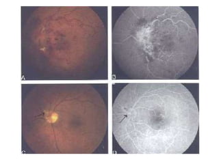 RETINAL VEIN THROMBOLYSISRetinal vein cannulation allows t-PA to be delivered under direct view into the retinal vein to cause thrombolysis.t-PA is injected early after onset of the vein occlusion, collateral vessels will not yet have developed and the t-PA may then reach the desired site.