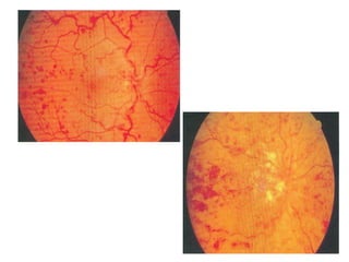  HEMI-CENTRAL RETINAL VEIN OBSTRUCTION