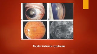 Ocular ischemic syndrome
 
