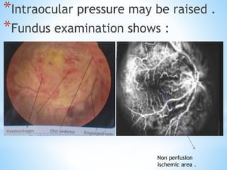 *Intraocular pressure may be raised .
*Fundus examination shows :
Non perfusion
ischemic area .
 