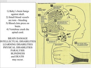 1) Baby’s brain bangs 
against skull. 
2) Small blood vessels 
are torn - bleeding 
3) Blood clots press on 
brain. 
4) Vertebrae crush the 
spinal cord. 
BRAIN DAMAGE 
INTELLECTUAL DISABILITIES 
LEARNING DISABILITIES 
PHYSICAL DISABILITIES 
PARALYSIS 
BLINDNESS 
and DEATH 
may occur. 
 