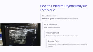 Cryoneurolysis For Chronic Migraine An Important Interventional Pain cryoneurolysis-for-chronic-migraine-an-important-interventional-pain