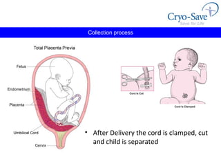 Collection process After Delivery the cord is clamped, cut and child is separated 