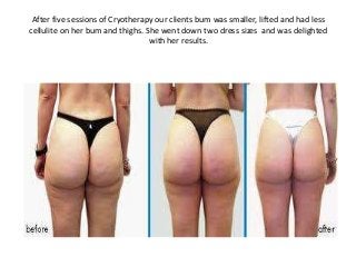 After five sessions of Cryotherapy our clients bum was smaller, lifted and had less
cellulite on her bum and thighs. She went down two dress sizes and was delighted
with her results.
 