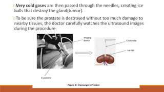 oVery cold gases are then passed through the needles, creating ice 
balls that destroy the gland(tumor). 
oTo be sure the prostate is destroyed without too much damage to 
nearby tissues, the doctor carefully watches the ultrasound images 
during the procedure 
 