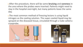 oAfter the procedure, there will be some bruising and soreness in 
the area where the probes were inserted. Patients might need to 
stay in the hospital overnight, but many patients leave the same 
day. 
oThe most common method of freezing lesions is using liquid 
nitrogen as the cooling solution. The super-cooled liquid may be 
sprayed on the diseased tissue, circulated through a tube called a 
cryoprobe. 
 